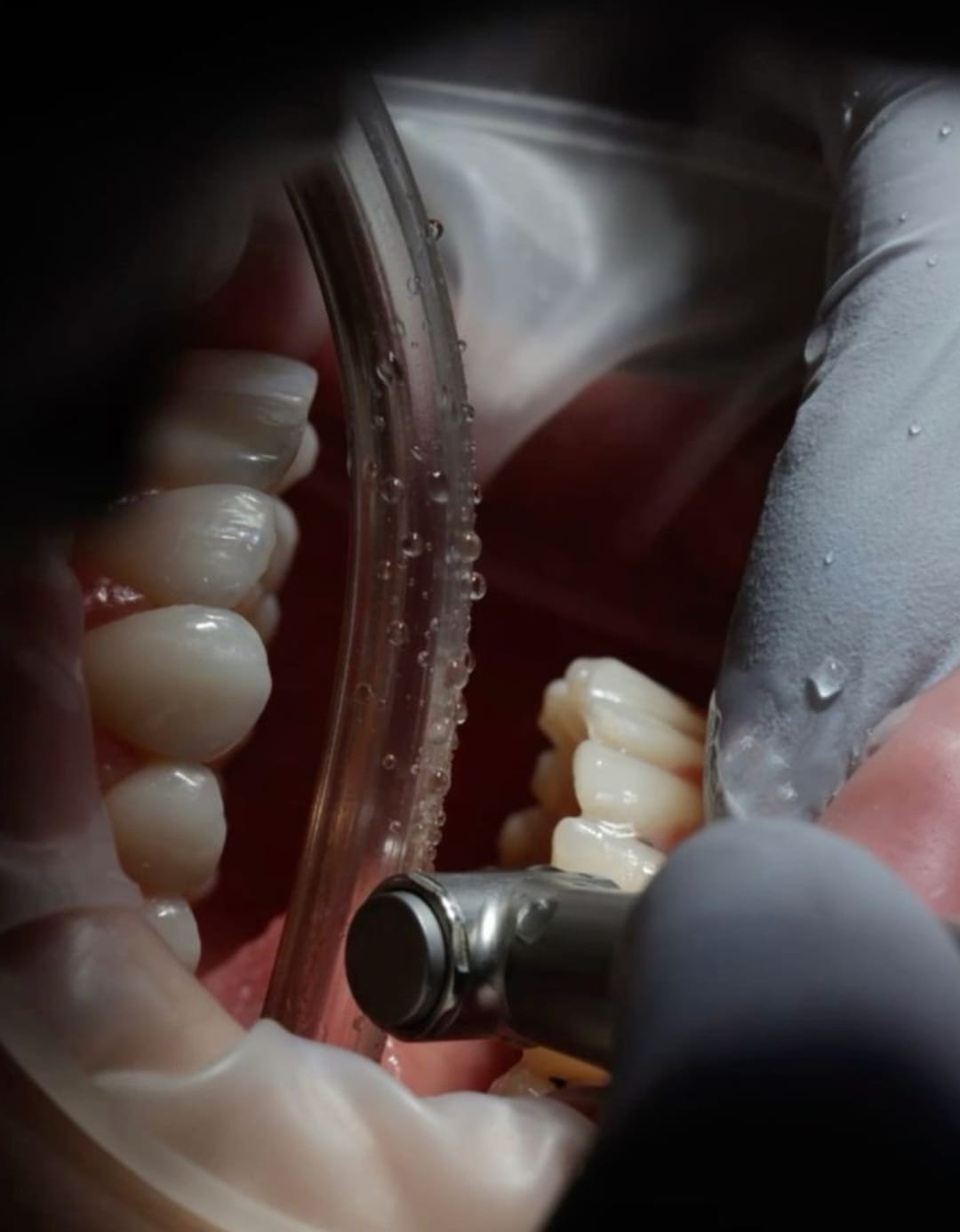 Bacterii in cavitatea orala